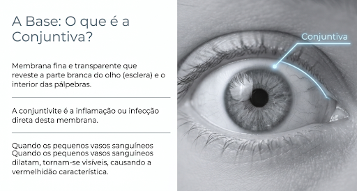 Imagem ilustrativa mostrando a conjuntiva onde conjuntivite ataca!